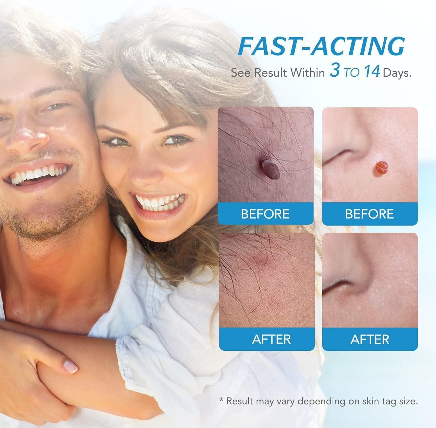 2 in 1 Skin Tag Remover Kit - Painless www.trikaro.com
